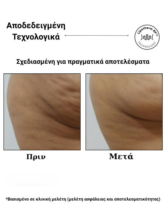 Sensifirm™ – Συσκευή Σύσφιξης & Αντιμετώπισης Κυτταρίτιδας με Ραδιοσυχνότητες (RF) - Image 7