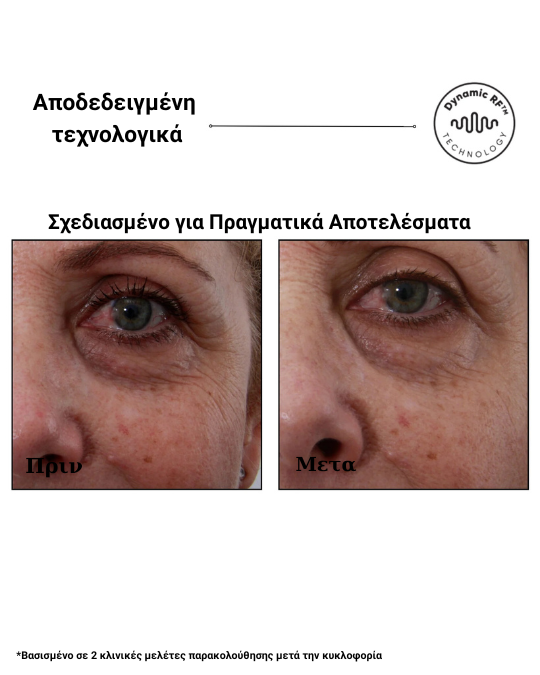 Sensilift™ – Συσκευή Ραδιοσυχνοτήτων (RF) για Ανόρθωση & Σύσφιξη Δέρματος - Image 5
