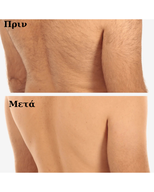 Sensilight Pro – Επαγγελματική IPL συσκευή αποτρίχωσης με απεριόριστα flashes - Image 13