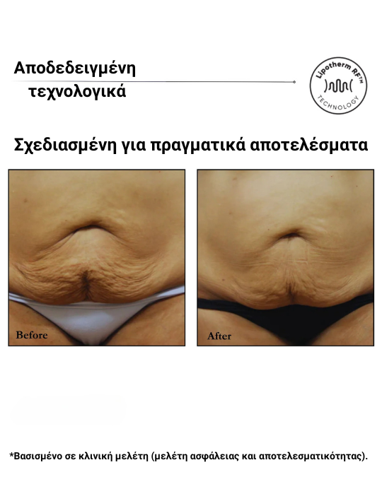 Sensifirm™ – Συσκευή Σύσφιξης & Αντιμετώπισης Κυτταρίτιδας με Ραδιοσυχνότητες (RF) - Image 9