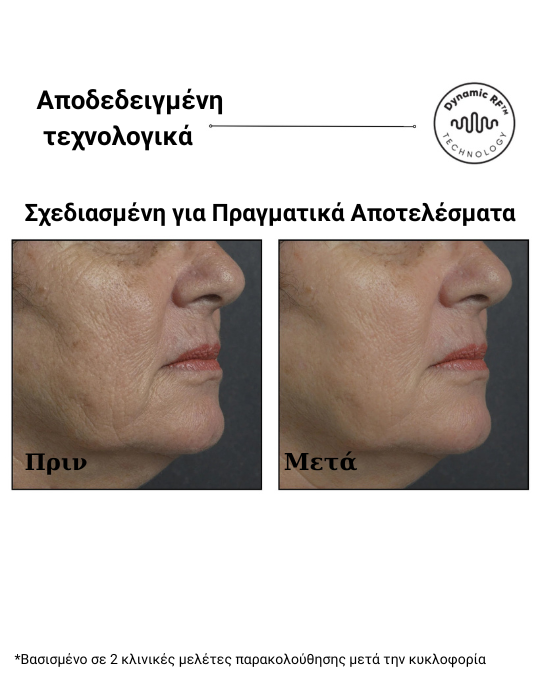 Sensilift™ – Συσκευή Ραδιοσυχνοτήτων (RF) για Ανόρθωση & Σύσφιξη Δέρματος - Image 4
